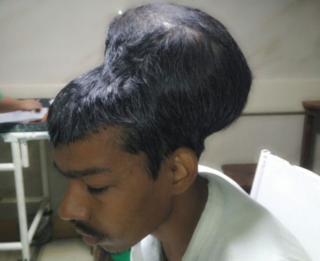 Індійські лікарі видалили "найбільшу пухлину мозку" у світі
