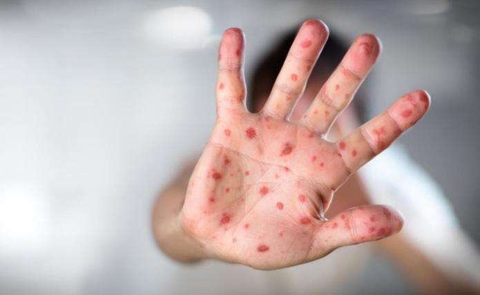 У Чорній Тисі станом на сьогодні зареєстровано 76 випадків кору
