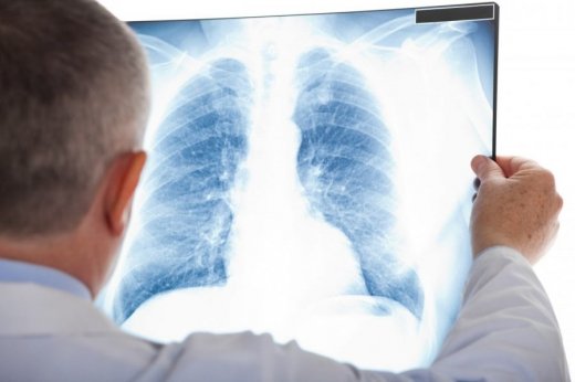 Україна – на 2 місці в Європі за захворюваністю на туберкульоз