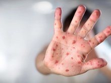 На Закарпатті з початку року на кір захворіли 3014 людей: 565 дорослих і 2449 дітей