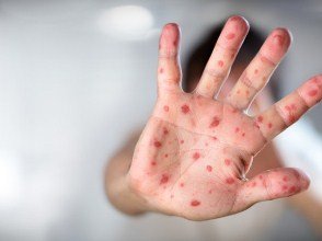 З початку року на кір захворіло понад три тисячі закарпатців