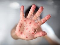 Вакцинація під час спалаху кору: кому потрібна, протипоказання та алергії