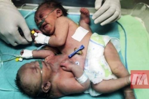 Лікарі розділили близнючок, які народились зі спільними животом та ногою
