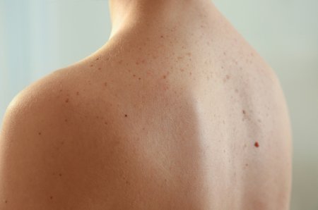 7 порад, як убезпечити себе від раку шкіри